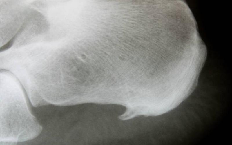 درمان-خار-استخوانی