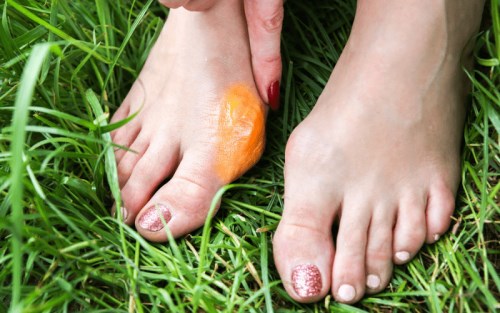 درمان-خانگی-بیرون-زدگی-استخوان-شست-پا