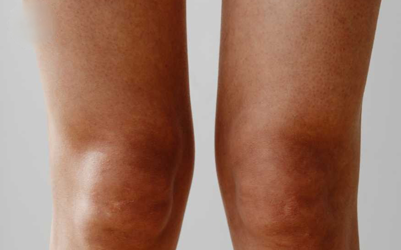 درمان-زانوی-ضربه-دری