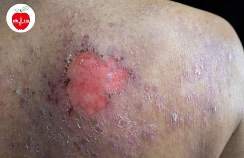 درمان-زخم-بستر-4