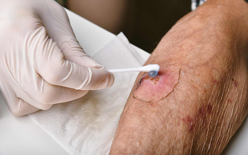 درمان-زخم-در-طب-سنتی درمان-زخم-در-طب-سنتی