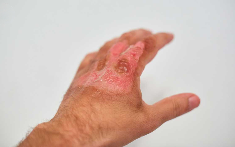 درمان-سوختگی-پوست درمان-سوختگی-پوست