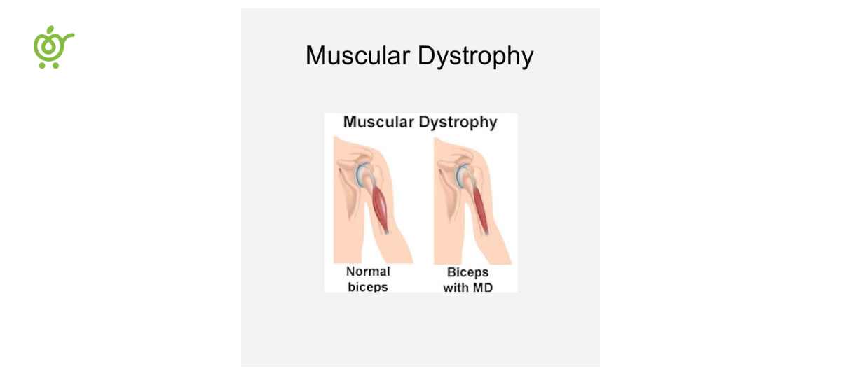 دیستروفی-عضلانی-1 روشهای درمان دیستروفی عضلانی