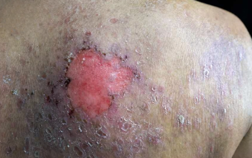 راه-موثر-در-درمان-زخم-بستر