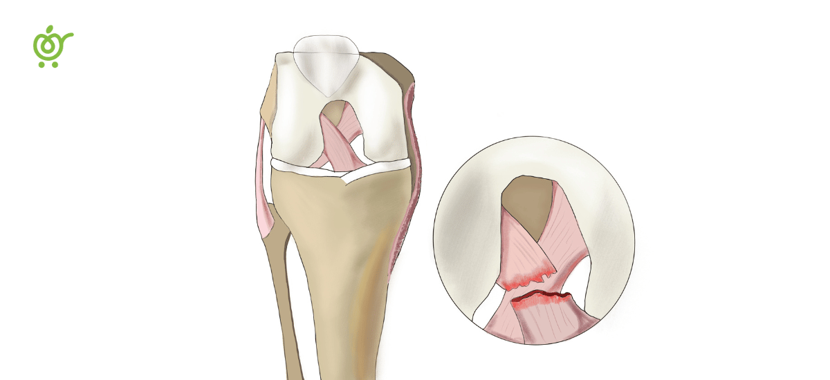 راه‌های درمان رباط صلیبی