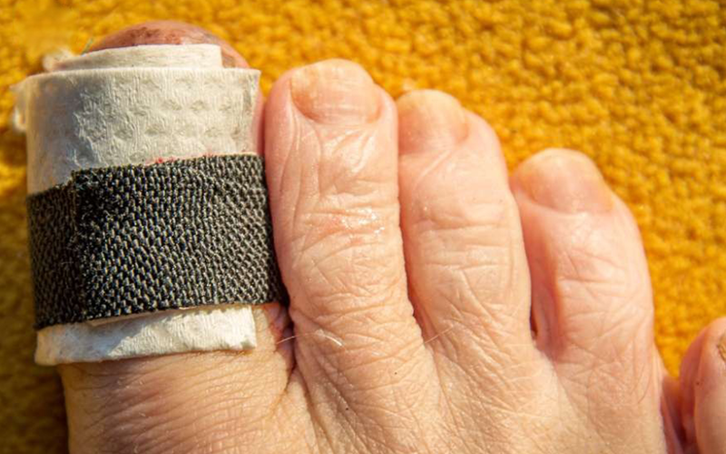 زخم-انگشت-شست-پا-نشانه-چیست؟ زخم-انگشت-شست-پا-نشانه-چیست؟