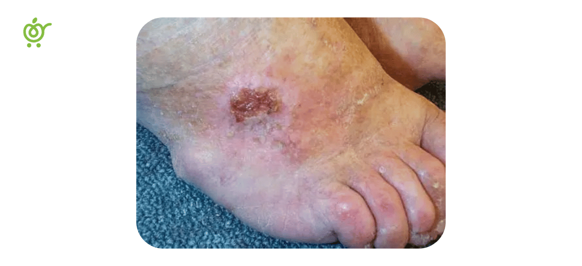 زخم-سرطانی-1 زخم-سرطانی-1