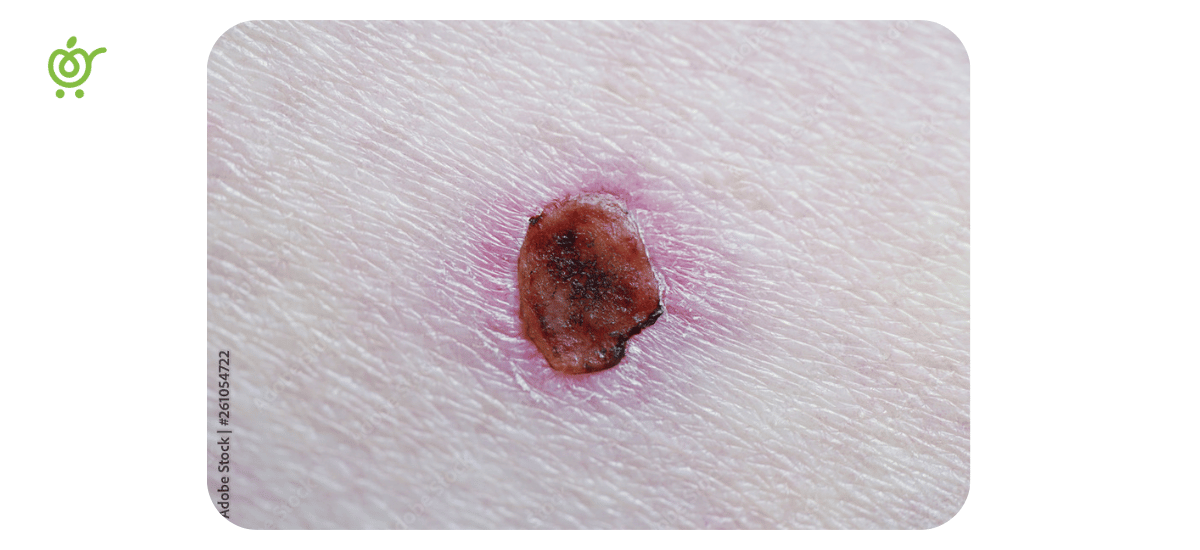 زخم-سرطانی-2 زخم-سرطانی-2