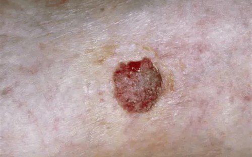زخم-سرطانی