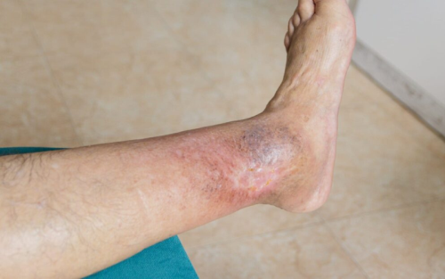 زخم-وریدی-چیست