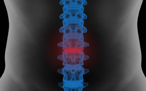 سرخوردگی-مهره-کمری