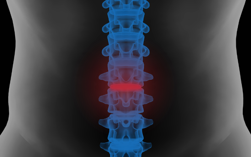 سرخوردگی-مهره-کمری سرخوردگی-مهره-کمری