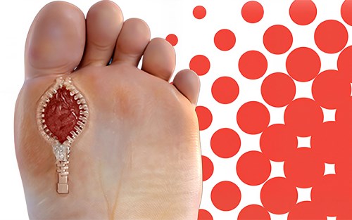 شاخص-زخم-دیابتی