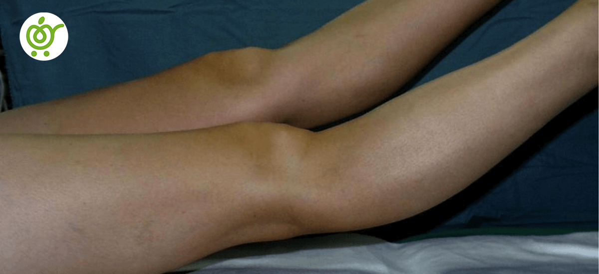 عقب-زدگی-زانو-چیست؟ عقب-زدگی-زانو-چیست؟