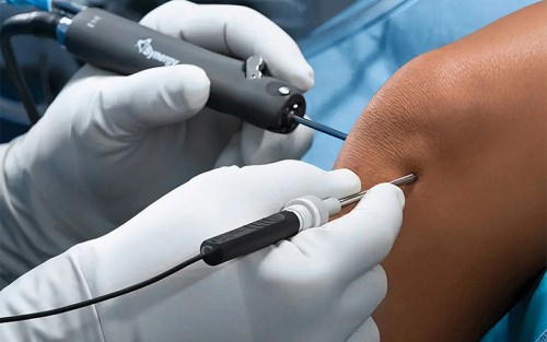 عکس-شاخص-وبلاگ-آرتروسکوپی-2