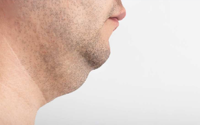 غبغب-را-چگونه-از-بین-ببریم؟ غبغب-را-چگونه-از-بین-ببریم؟