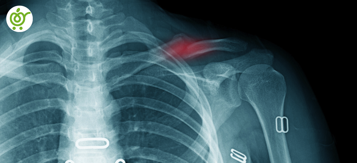 مدت-زمان-جوش-خوردن-شکستگی-ترقوه