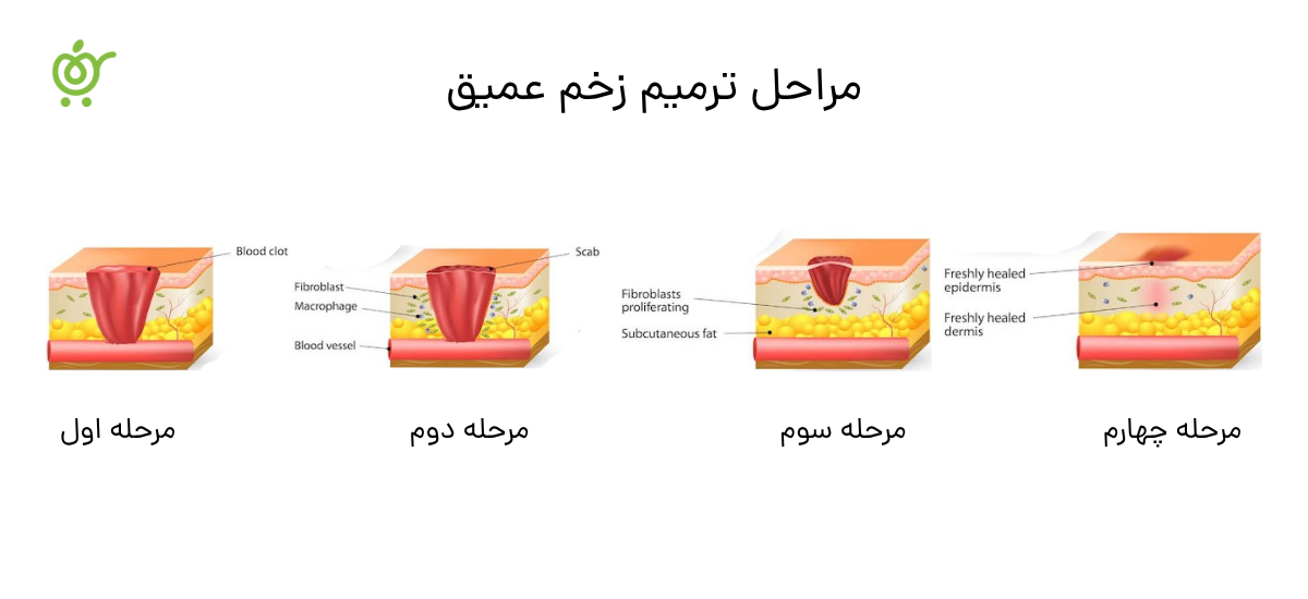 مراحل-ترمیم-زخم-عمیق-(1)