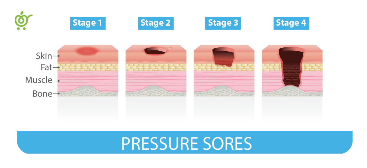 مراحل-زخم-بستر انواع زخم بستر چیست؟