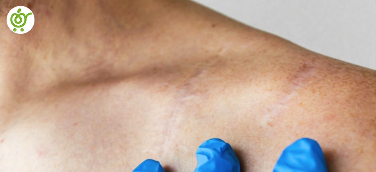 مراقب‌های-بعد-از-شکستگی