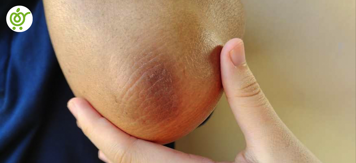 نرم-شدن-یا-ضعیف-شدن-غضروف-مفصلی نرم-شدن-یا-ضعیف-شدن-غضروف-مفصلی