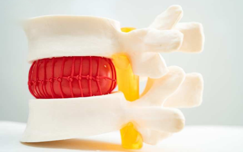 همه-چیز-در-مورد-دیسک-کمر