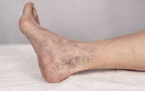 همه-چیز-در-مورد-رگ‌های-واریسی