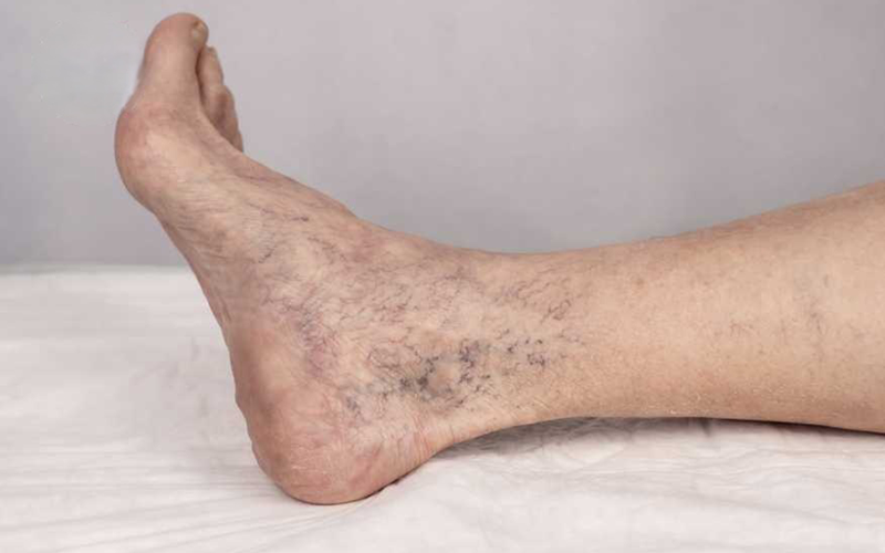 همه-چیز-در-مورد-رگ‌های-واریسی