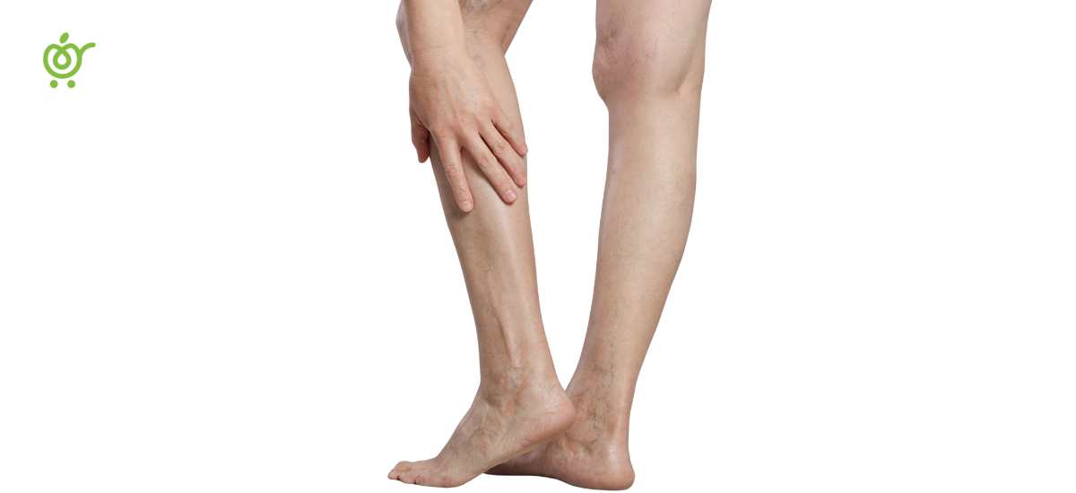 ورزش-برای-واریس-پا ورزش برای واریس پا